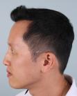 After Hair Transplant&nbsp;Front